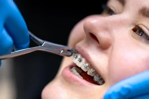 Affordable Braces Package Dubai: A Complete Guide to Types and Costs
